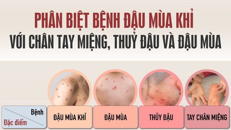 dấu hiệu bệnh đậu mùa khỉ