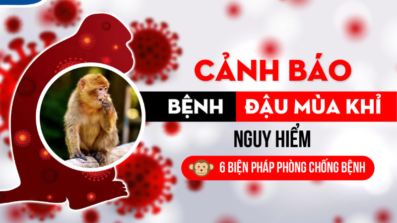 bệnh đậu mùa khỉ ở việt nam