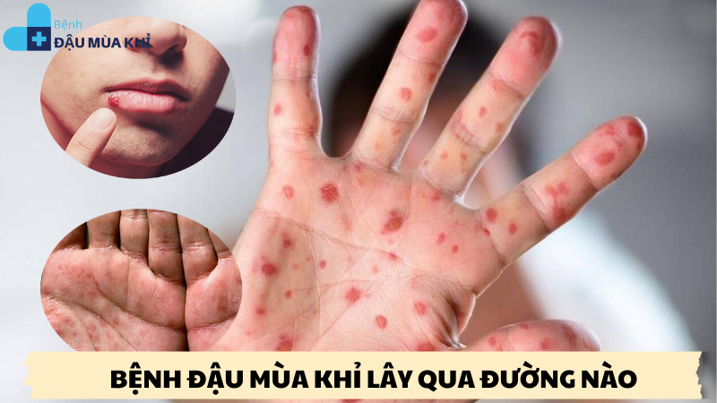 bệnh đậu mùa khỉ lây qua đường nào