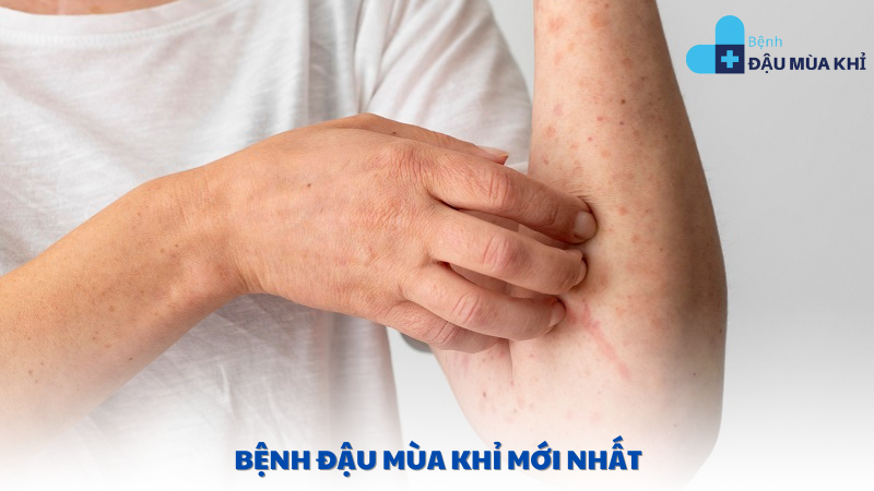 bệnh đậu mùa khỉ mới nhất