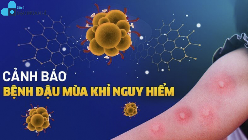 phòng bệnh đậu mùa khỉ
